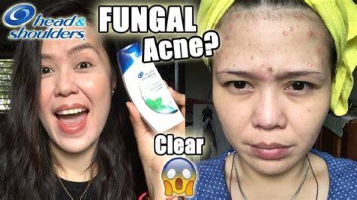 Is Using Head and Shoulders for Acne Legit?
